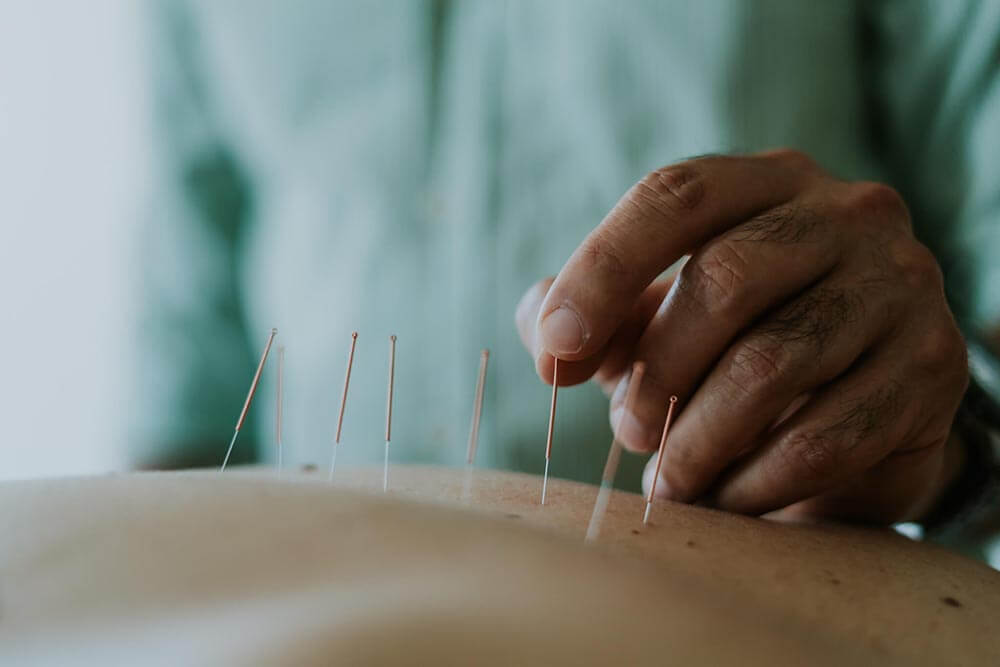 Intramuscular Stimulation  Calgary Acupuncture Clinic